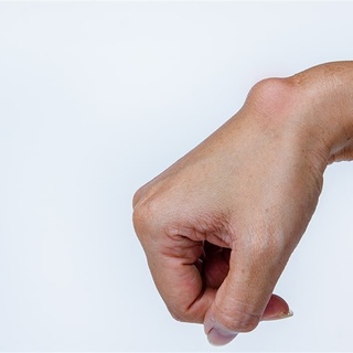 Kist nedir? Belirtileri nelerdir?