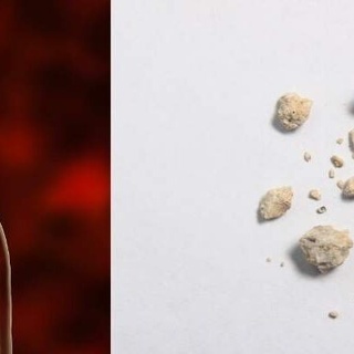 Uzmanlar uyarıyor; böbrek taşı gebelikte erken doğum riskini artırıyor!