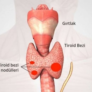 Uzmanlardan tiroid nodülü uyarısı